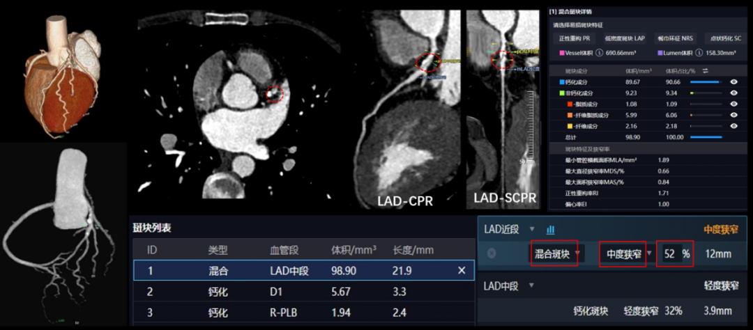 联影有哪些CT【影领未来】精准所见，安全所托！我院联影uCT 968高端CT 正式 “上岗”_https://www.jmylbn.com_新闻资讯_第6张