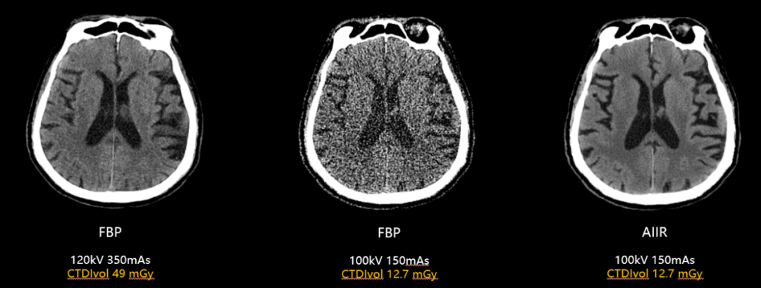 联影有哪些CT【影领未来】精准所见，安全所托！我院联影uCT 968高端CT 正式 “上岗”_https://www.jmylbn.com_新闻资讯_第5张