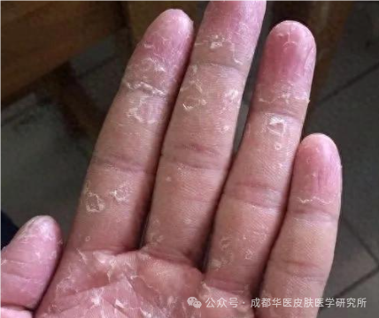 导致手足癣的原因是什么，如何治疗好得快？牢记这4点