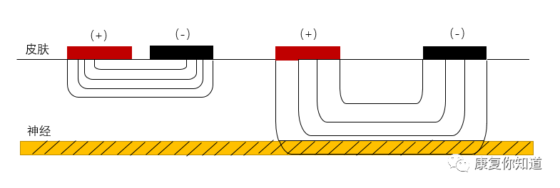 中频为什么能镇痛收藏！中频电疗法的治疗作用！_https://www.jmylbn.com_新闻资讯_第7张