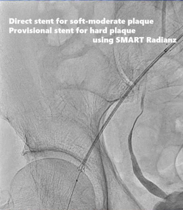 动脉长鞘怎么置入桡胜一筹丨原口拓也：经桡动脉入路在下肢动脉疾病腔内治疗中的优势——RADIANZ应用经验_https://www.jmylbn.com_新闻资讯_第25张