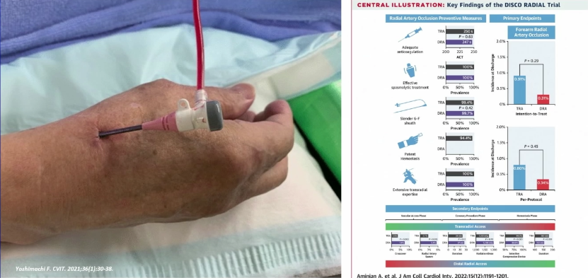 动脉长鞘怎么置入桡胜一筹丨原口拓也：经桡动脉入路在下肢动脉疾病腔内治疗中的优势——RADIANZ应用经验_https://www.jmylbn.com_新闻资讯_第41张