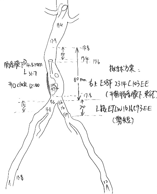 单猪尾支架怎么放【腹具匠新】吴华平教授团队：ENDURANT IIs 分叉支架开窗束径保留 IMA 治疗腹主动脉穿透性溃疡_https://www.jmylbn.com_新闻资讯_第22张