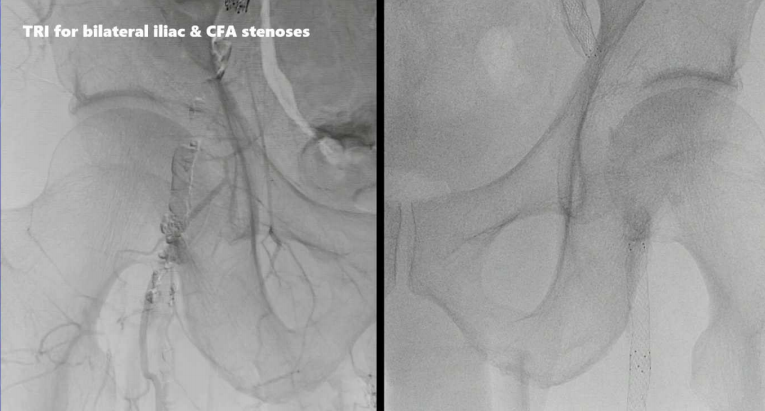 动脉长鞘怎么置入桡胜一筹丨原口拓也：经桡动脉入路在下肢动脉疾病腔内治疗中的优势——RADIANZ应用经验_https://www.jmylbn.com_新闻资讯_第35张