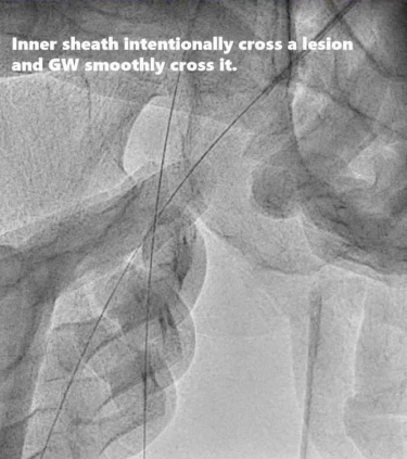 动脉长鞘怎么置入桡胜一筹丨原口拓也：经桡动脉入路在下肢动脉疾病腔内治疗中的优势——RADIANZ应用经验_https://www.jmylbn.com_新闻资讯_第24张