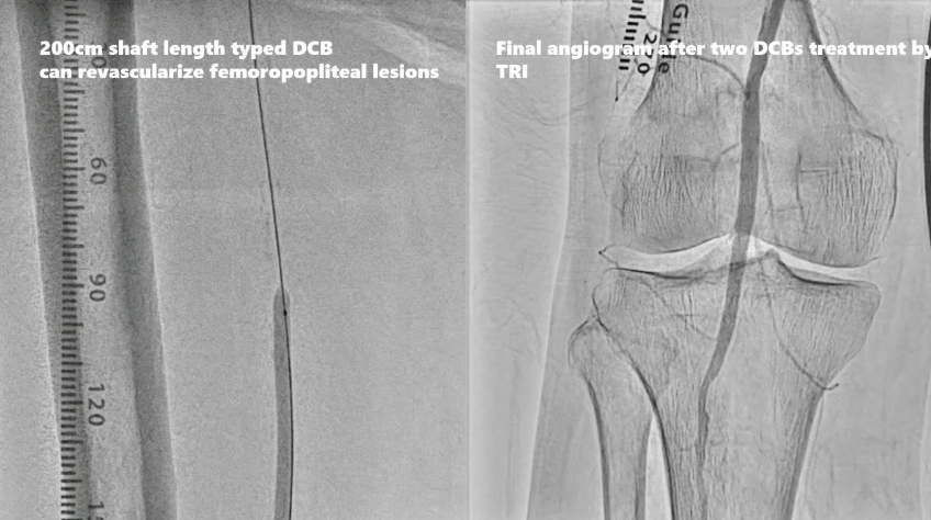 动脉长鞘怎么置入桡胜一筹丨原口拓也：经桡动脉入路在下肢动脉疾病腔内治疗中的优势——RADIANZ应用经验_https://www.jmylbn.com_新闻资讯_第38张