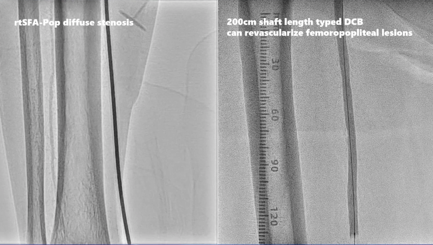 动脉长鞘怎么置入桡胜一筹丨原口拓也：经桡动脉入路在下肢动脉疾病腔内治疗中的优势——RADIANZ应用经验_https://www.jmylbn.com_新闻资讯_第37张