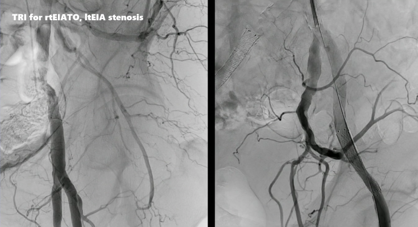 动脉长鞘怎么置入桡胜一筹丨原口拓也：经桡动脉入路在下肢动脉疾病腔内治疗中的优势——RADIANZ应用经验_https://www.jmylbn.com_新闻资讯_第32张