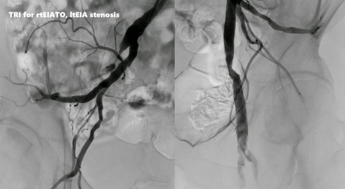 动脉长鞘怎么置入桡胜一筹丨原口拓也：经桡动脉入路在下肢动脉疾病腔内治疗中的优势——RADIANZ应用经验_https://www.jmylbn.com_新闻资讯_第30张