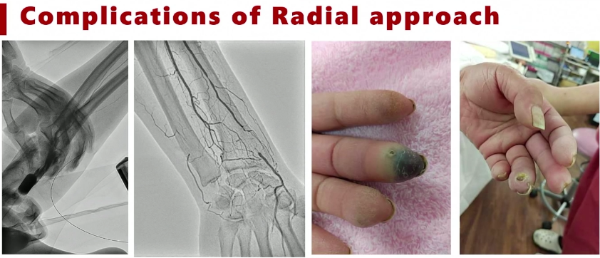 动脉长鞘怎么置入桡胜一筹丨原口拓也：经桡动脉入路在下肢动脉疾病腔内治疗中的优势——RADIANZ应用经验_https://www.jmylbn.com_新闻资讯_第17张