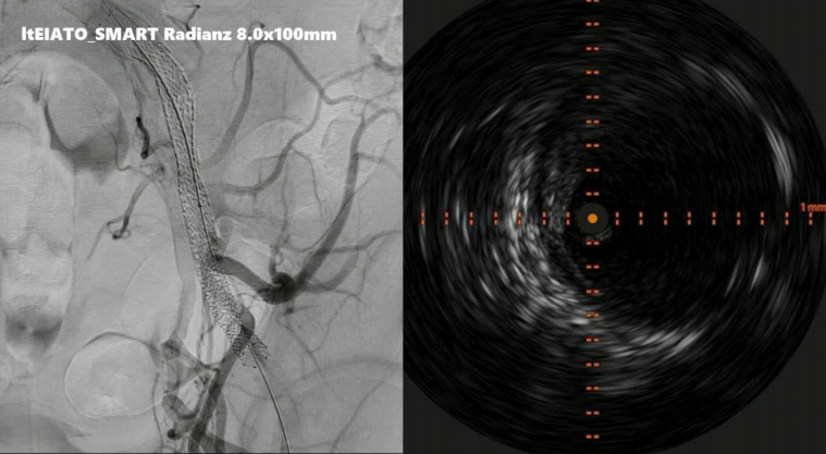 动脉长鞘怎么置入桡胜一筹丨原口拓也：经桡动脉入路在下肢动脉疾病腔内治疗中的优势——RADIANZ应用经验_https://www.jmylbn.com_新闻资讯_第34张