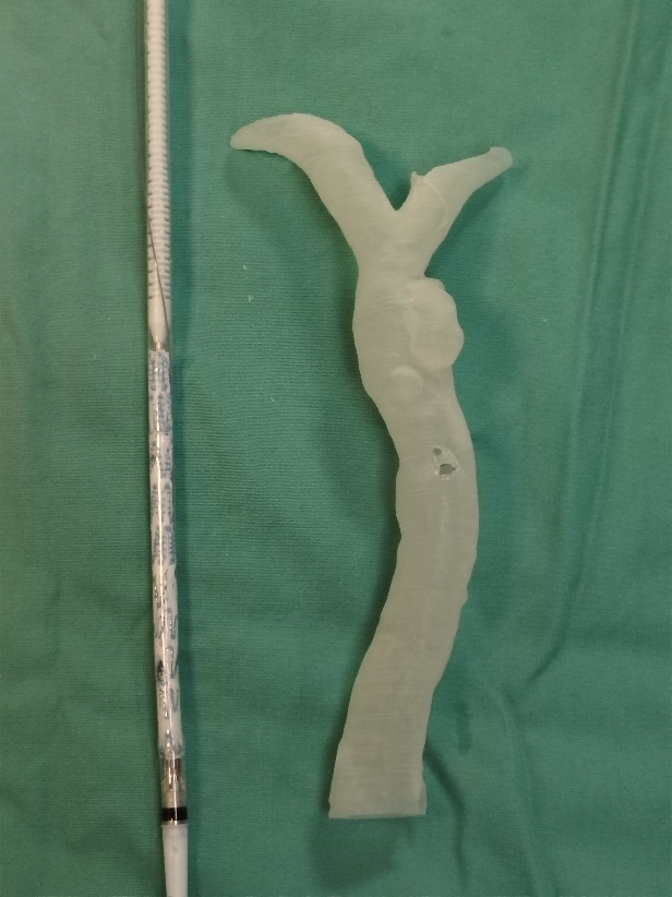 单猪尾支架怎么放【腹具匠新】吴华平教授团队：ENDURANT IIs 分叉支架开窗束径保留 IMA 治疗腹主动脉穿透性溃疡_https://www.jmylbn.com_新闻资讯_第24张