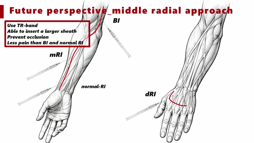 动脉长鞘怎么置入桡胜一筹丨原口拓也：经桡动脉入路在下肢动脉疾病腔内治疗中的优势——RADIANZ应用经验_https://www.jmylbn.com_新闻资讯_第42张