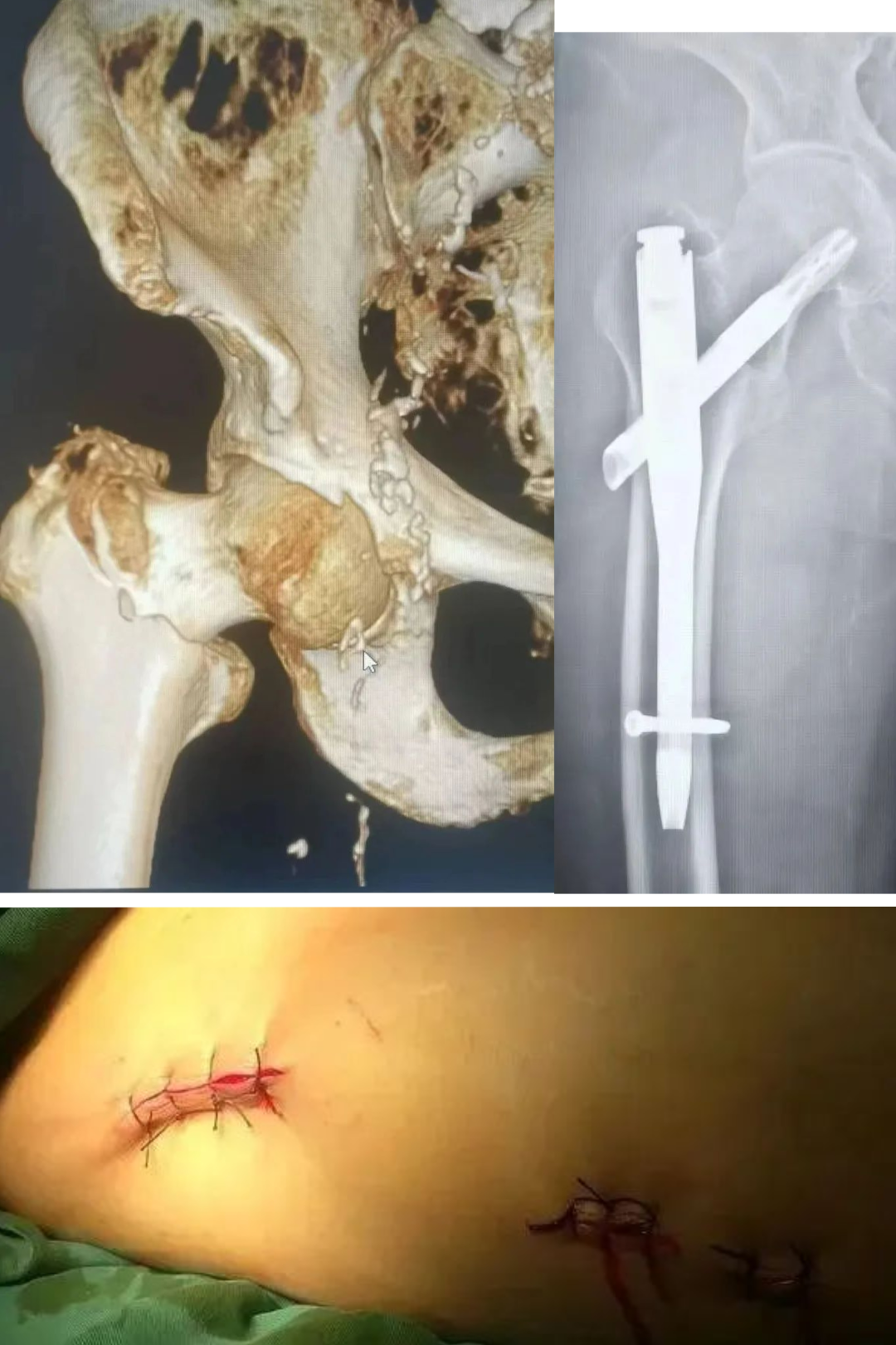 肋骨固定板怎么拆骨折里的钢板螺钉：是时候说“再见”了吗？—— 关于内固定物取与不取的全面解读_https://www.jmylbn.com_新闻资讯_第7张