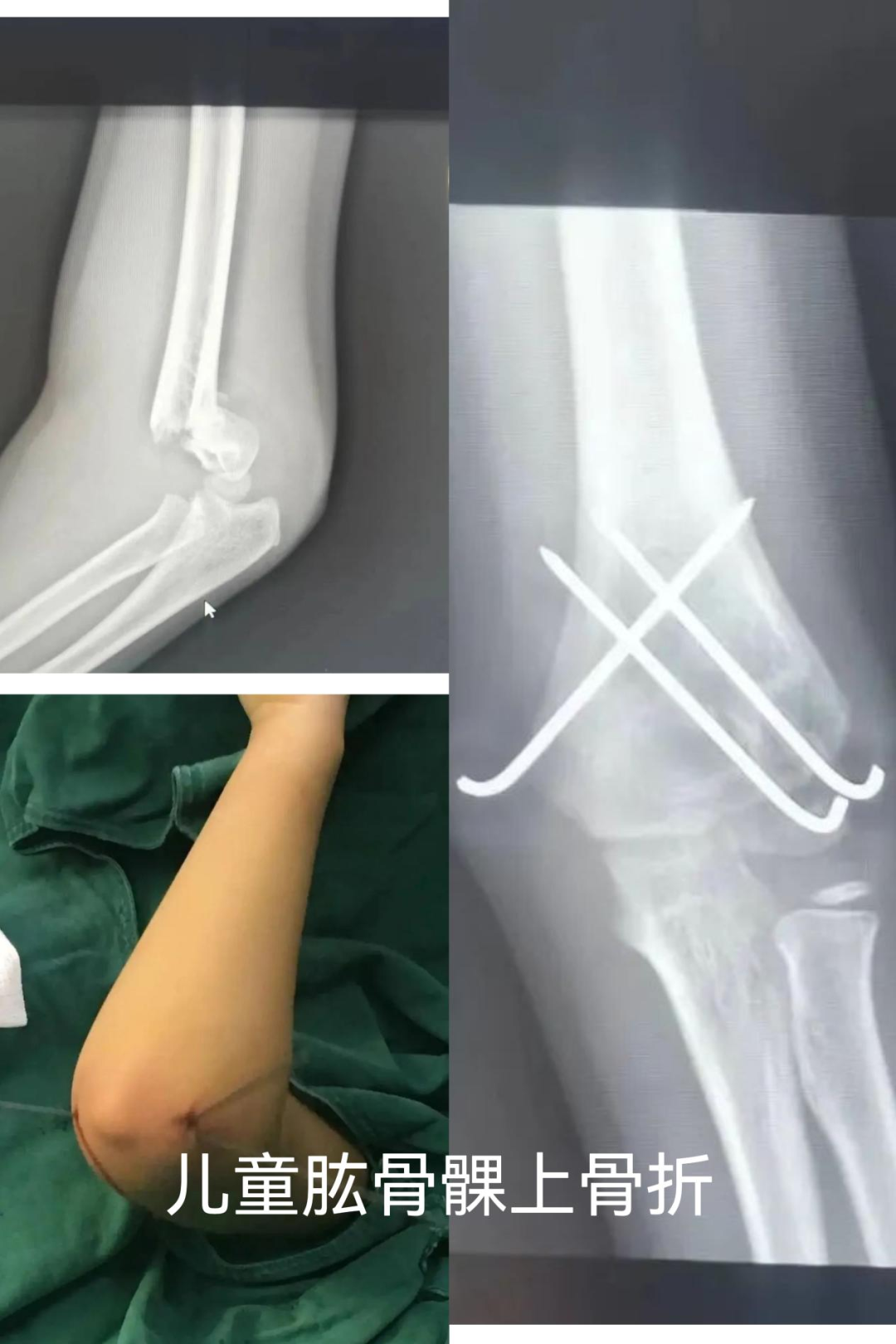 肋骨固定板怎么拆骨折里的钢板螺钉：是时候说“再见”了吗？—— 关于内固定物取与不取的全面解读_https://www.jmylbn.com_新闻资讯_第3张