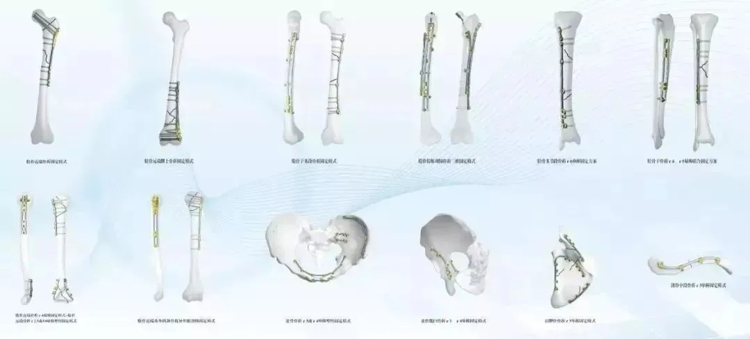 肋骨固定板怎么拆骨折里的钢板螺钉：是时候说“再见”了吗？—— 关于内固定物取与不取的全面解读_https://www.jmylbn.com_新闻资讯_第11张