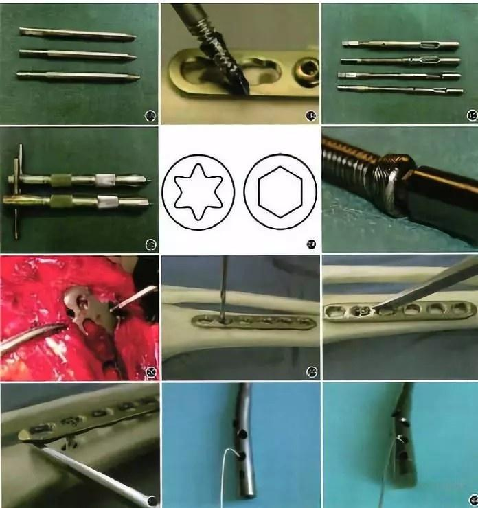肋骨固定板怎么拆骨折里的钢板螺钉：是时候说“再见”了吗？—— 关于内固定物取与不取的全面解读_https://www.jmylbn.com_新闻资讯_第9张