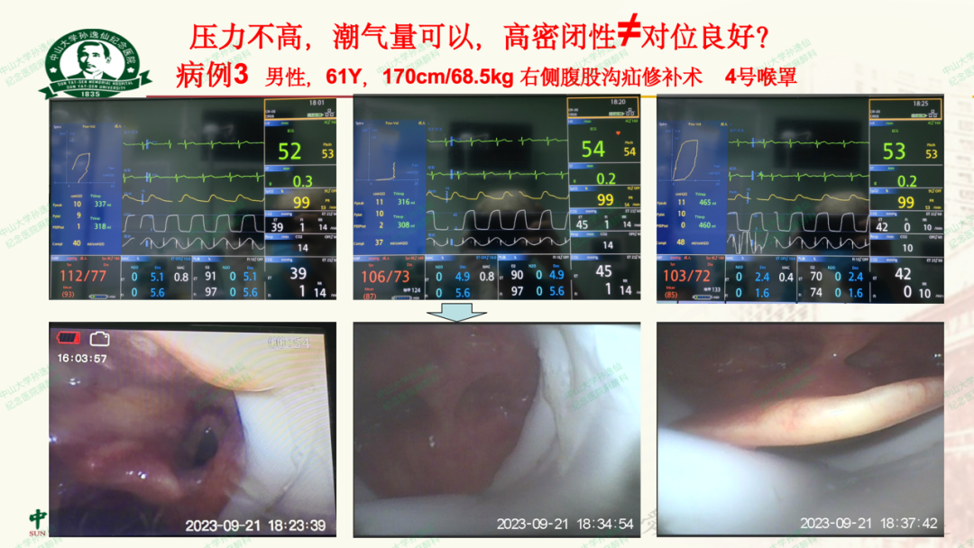 为什么要用喉罩浅谈喉罩的临床应用_https://www.jmylbn.com_新闻资讯_第31张