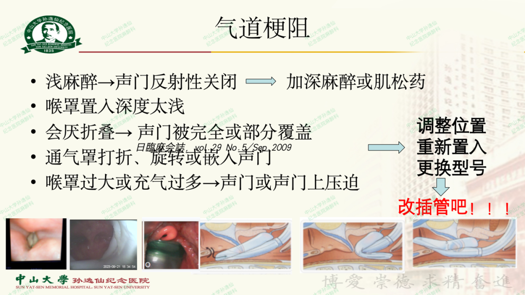 为什么要用喉罩浅谈喉罩的临床应用_https://www.jmylbn.com_新闻资讯_第25张