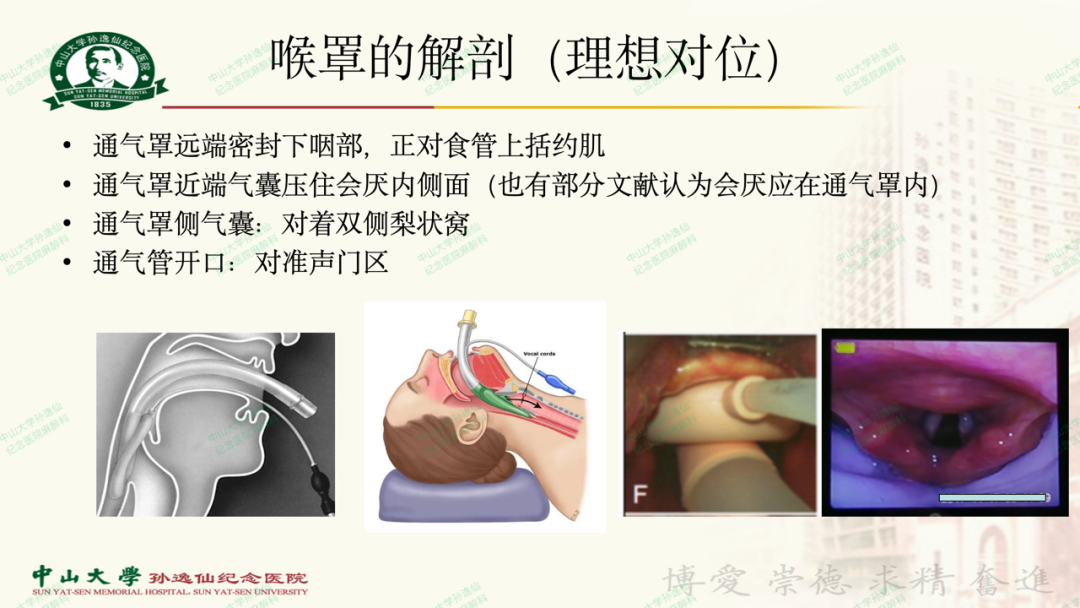 为什么要用喉罩浅谈喉罩的临床应用_https://www.jmylbn.com_新闻资讯_第6张