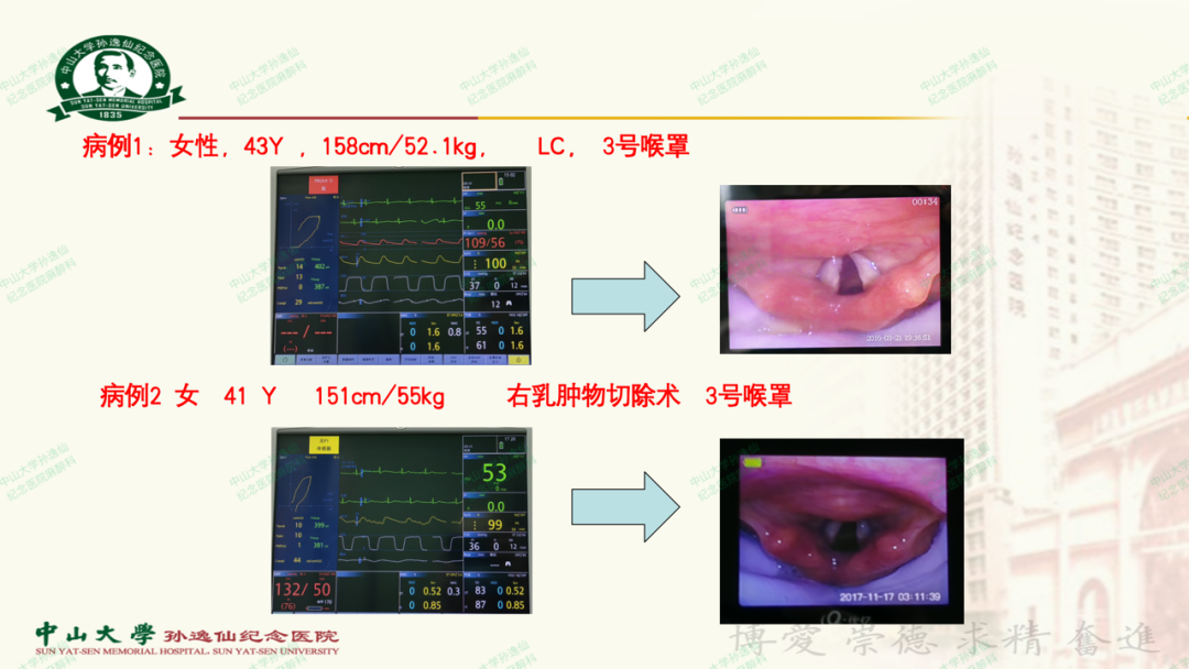 为什么要用喉罩浅谈喉罩的临床应用_https://www.jmylbn.com_新闻资讯_第28张