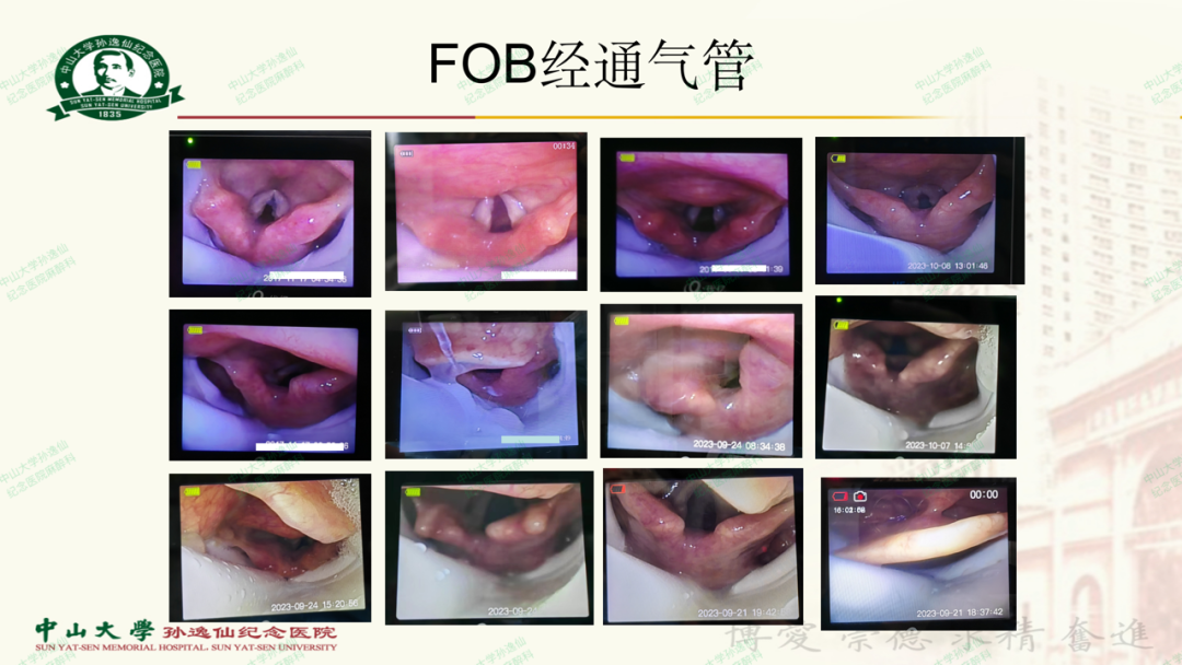 为什么要用喉罩浅谈喉罩的临床应用_https://www.jmylbn.com_新闻资讯_第17张