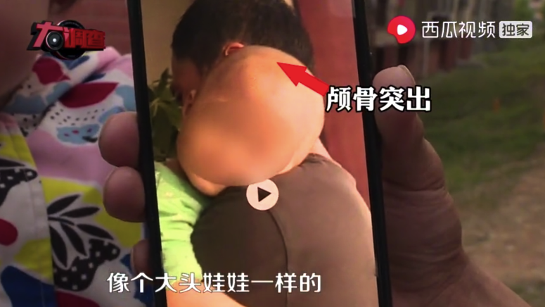 起紅疹、佝僂病、發育停止...湖南出現多名大頭娃娃 只因喝了這款「毒奶粉」 親子 第4張