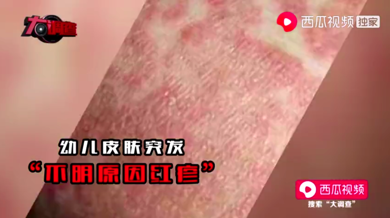 起紅疹、佝僂病、發育停止...湖南出現多名大頭娃娃 只因喝了這款「毒奶粉」 親子 第3張