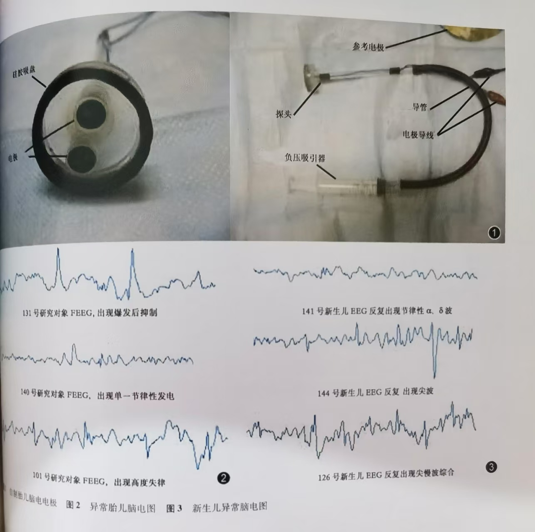 bis电极怎么接温故知新​｜胎儿脑电图及其定量分析用于产时胎儿窘迫诊断的研究_https://www.jmylbn.com_新闻资讯_第3张