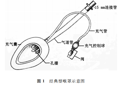 为什么要用喉罩温故知新​｜喉罩通气在新生儿复苏中的应用和评价_https://www.jmylbn.com_新闻资讯_第1张