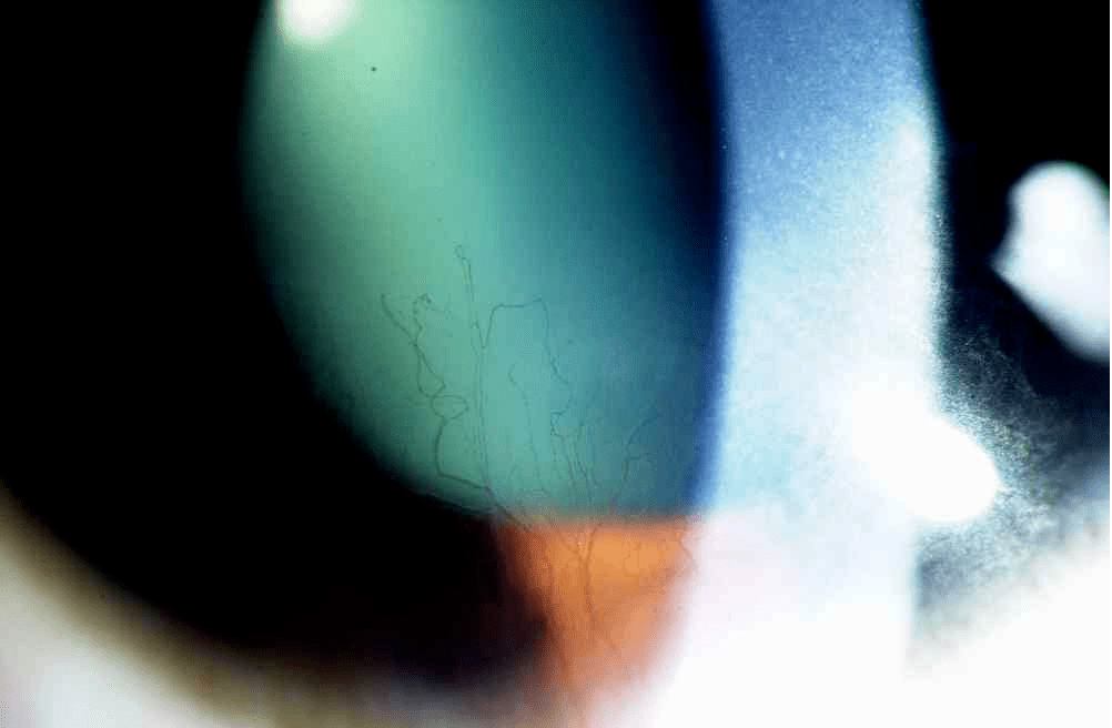 裂隙灯上光源是什么裂隙灯显微镜常用检查方法_https://www.jmylbn.com_新闻资讯_第11张