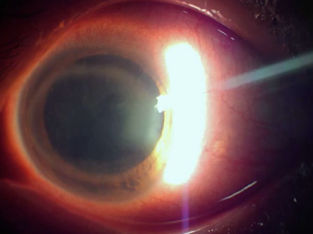 裂隙灯上光源是什么裂隙灯显微镜常用检查方法_https://www.jmylbn.com_新闻资讯_第12张