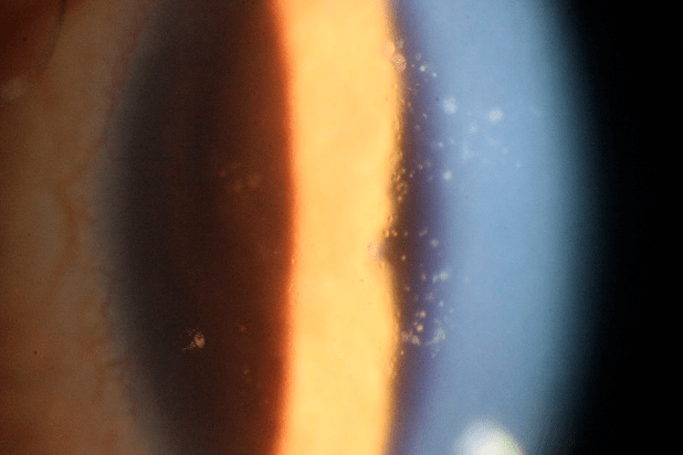 裂隙灯上光源是什么裂隙灯显微镜常用检查方法_https://www.jmylbn.com_新闻资讯_第13张