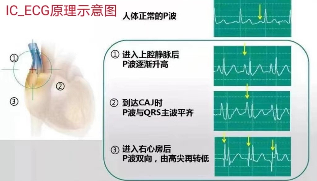 ecg 在医学上是什么意思生命通道的守护：我院老年医学中心一病区成功开展IC-ECG下PICC置管术_https://www.jmylbn.com_新闻资讯_第10张