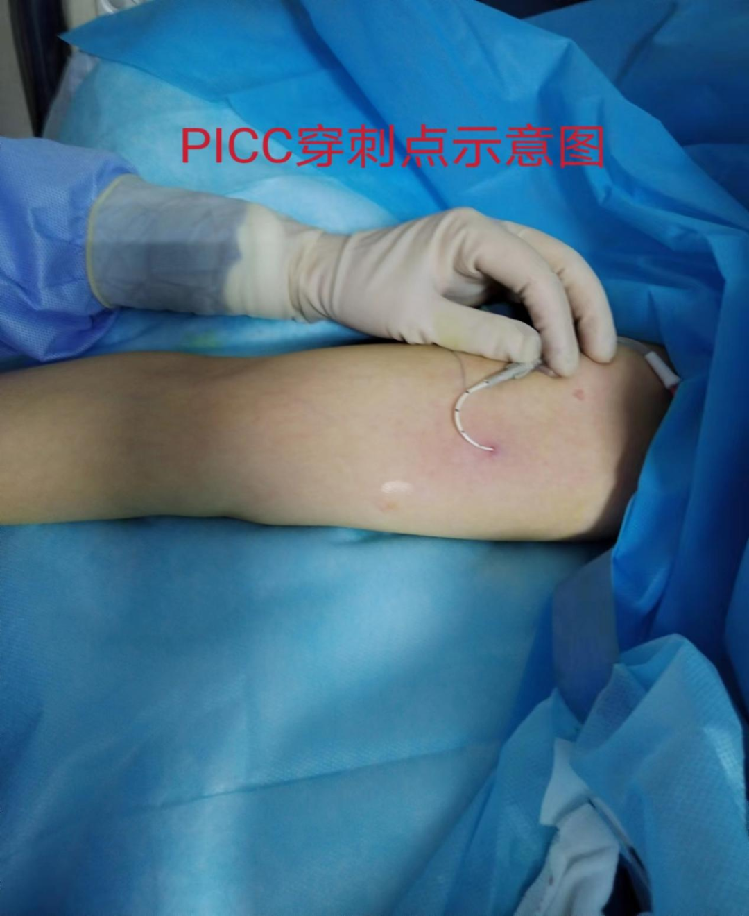 ecg 在医学上是什么意思生命通道的守护：我院老年医学中心一病区成功开展IC-ECG下PICC置管术_https://www.jmylbn.com_新闻资讯_第7张