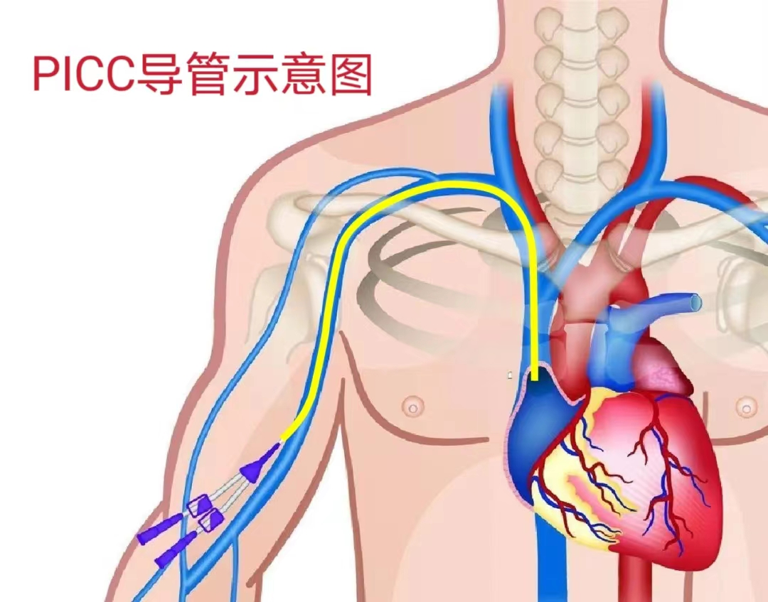 ecg 在医学上是什么意思生命通道的守护：我院老年医学中心一病区成功开展IC-ECG下PICC置管术_https://www.jmylbn.com_新闻资讯_第3张