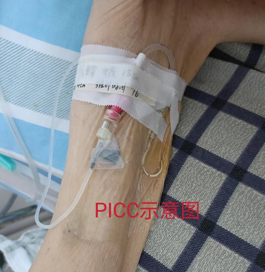 ecg 在医学上是什么意思生命通道的守护：我院老年医学中心一病区成功开展IC-ECG下PICC置管术_https://www.jmylbn.com_新闻资讯_第8张