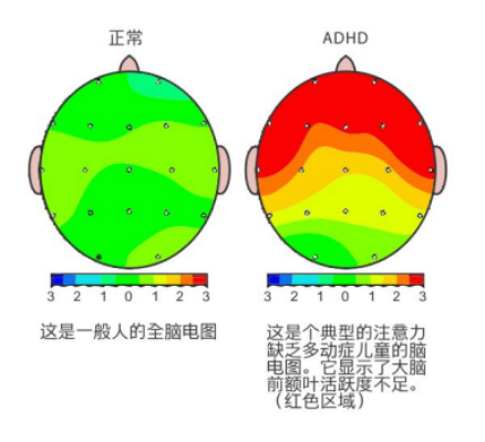 ld儿童怎么治疗ADHD共患学习障碍探秘：执行功能如何成为学习路上的绊脚石_https://www.jmylbn.com_新闻资讯_第6张