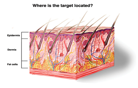 什么是光电治疗什么是光电治疗？它会损伤皮肤吗？_https://www.jmylbn.com_新闻资讯_第2张