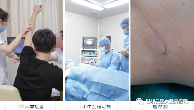 【云医大腋臭医院】怎么检查你的狐臭严不严重