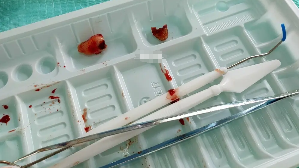 刮匙怎么使用牙龈分离器、刮匙简介_https://www.jmylbn.com_新闻资讯_第16张