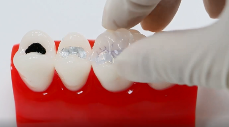 刮匙怎么使用牙龈分离器、刮匙简介_https://www.jmylbn.com_新闻资讯_第17张