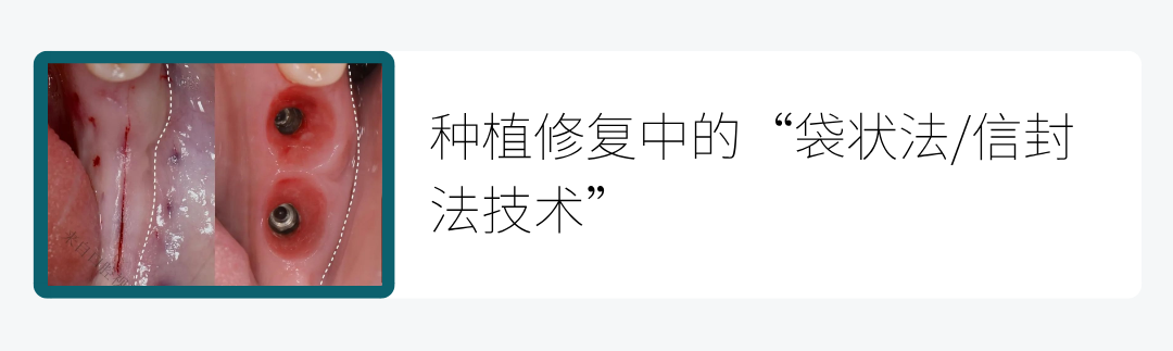 激光和电刀区别是什么重磅利好！口腔显微、激光、微动力、电刀、机器人等技术正式合规收费_https://www.jmylbn.com_新闻资讯_第17张