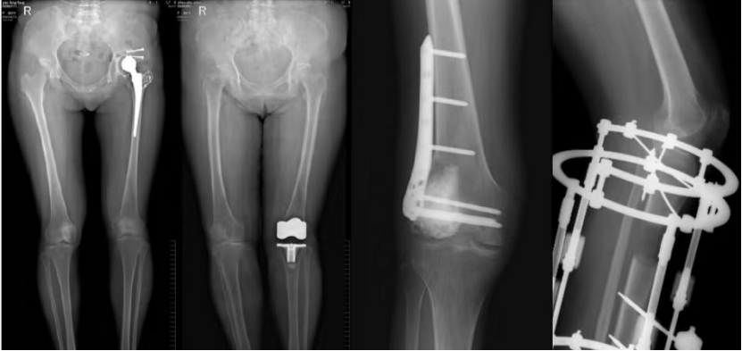 骨密度bmd是什么四川省妇幼保健院放射科新项目—骨密度影像技术（BMD）_https://www.jmylbn.com_新闻资讯_第6张