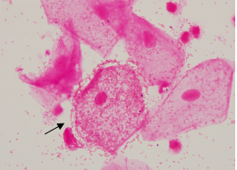 bv唾液酸酶阴性什么意思学术前沿 ｜ 加德纳菌一定会产生唾液酸苷酶吗？_https://www.jmylbn.com_新闻资讯_第3张