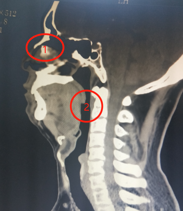 呼吸机怎么换氧气呼吸机里出来的是氧气吗？_https://www.jmylbn.com_新闻资讯_第5张