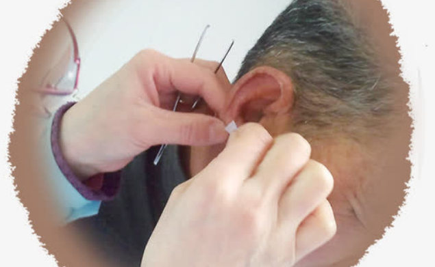 耳穴的操作方法及适应症