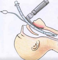 气管插管的管是什么全身麻醉气管插管，插的是什么管？_https://www.jmylbn.com_新闻资讯_第6张