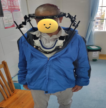 什么是外固定架骨科成功开展颈部寰椎骨折Halo架外固定技术_https://www.jmylbn.com_新闻资讯_第4张