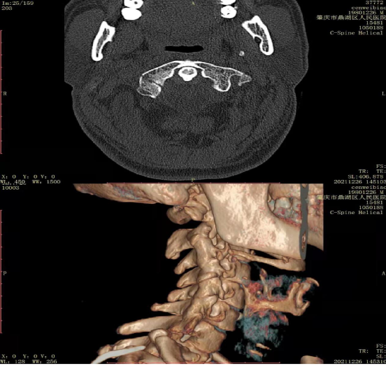 什么是外固定架骨科成功开展颈部寰椎骨折Halo架外固定技术_https://www.jmylbn.com_新闻资讯_第2张
